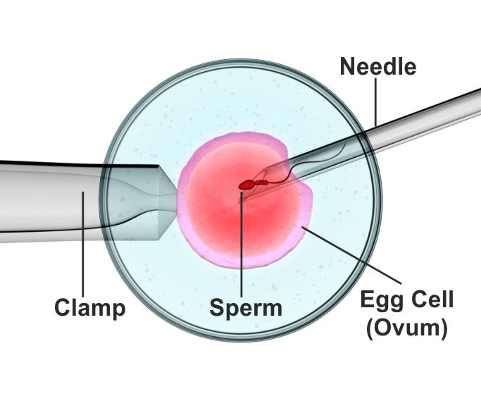 ICSI Microscopic View showing injection micropipette and holding pipette with mature oocyte